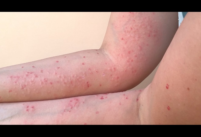 symptomen van apenpokken